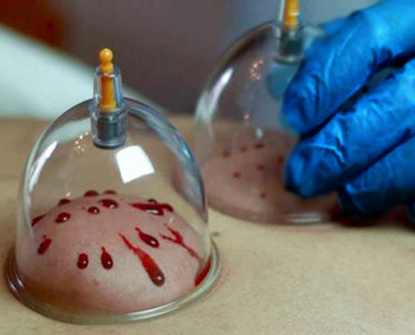  Hijama (Våt-koppning)
